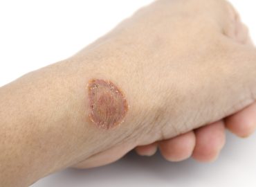 Why Does Ringworm Keep Coming Back? Causes and Prevention Tips Dermatologist explaining why ringworm keeps coming back and how to prevent recurrent fungal skin infections