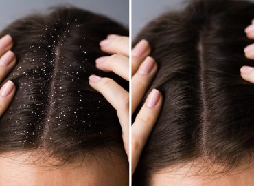 “Dandruff flakes on scalp showing dryness and irritation, highlighting symptoms of scalp issues.”