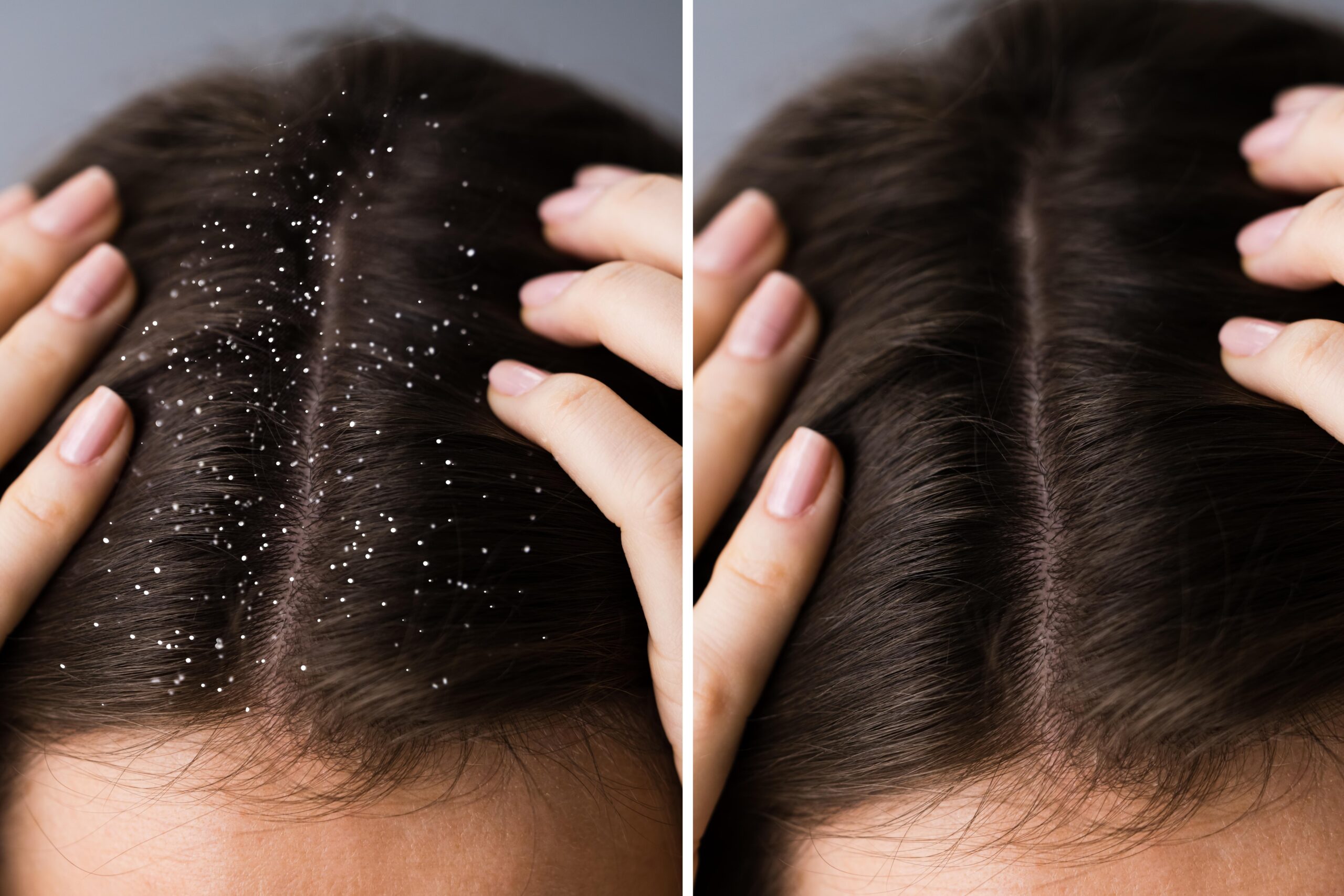 “Dandruff flakes on scalp showing dryness and irritation, highlighting symptoms of scalp issues.”