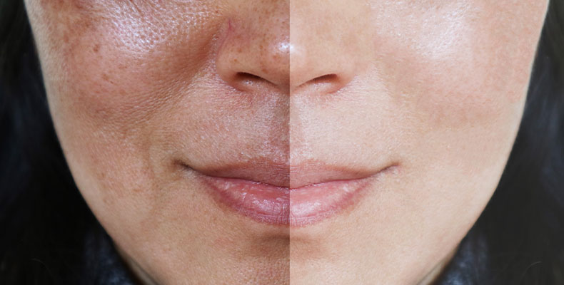 skin discoloration causes, treating hyperpigmentation, skincare for dark spots