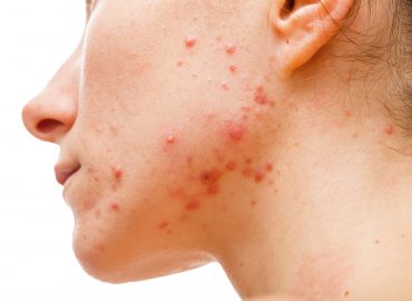 Types of Acne